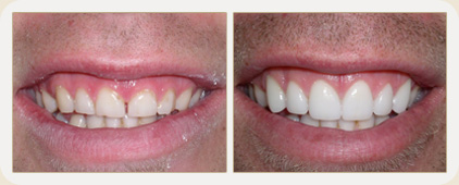 Side ved side bilde av tenner før og etter estetisk behandling.