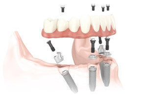 illustrasjon av tenner med tannimplantat